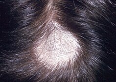 fungal hair skin infections scalp infection nails tinea treatment symptoms capitis prevention including sa infectious conditions toenails fingernails health wcm