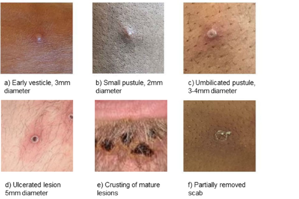 Individual monkeypox lesions