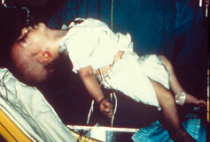 A child infected with botulism, demonstrating poor head control
