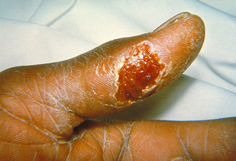 Thumb with skin ulcer of tularemia.