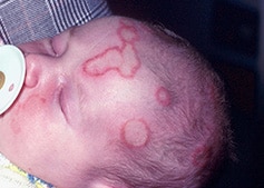 ringworm on a baby&aposs head