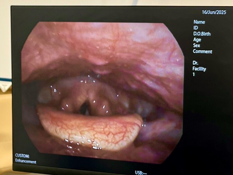 image showing the view of the voice box seen via the camera