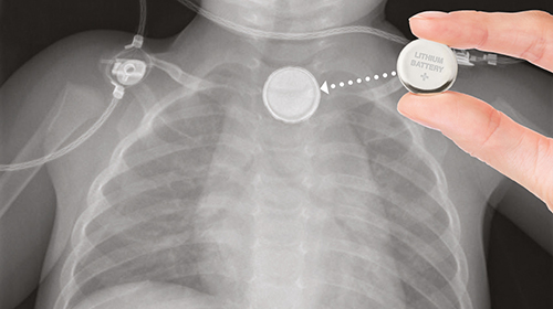 X-ray photo of lithium button battery wedged in childs throat
