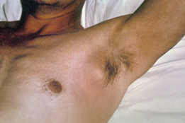 buboes - painful inflamed lymph nodes in the underarm