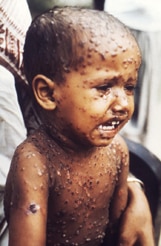 maculopapular skin rash, which was distributed over his face, arms, and torso in a manner classically representing smallpox.