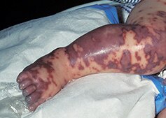 Meningococcal infection