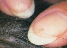 small white or brown oblong eggs ('nits') attached to the hair shafts shafts