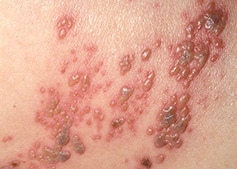Shingles blisters example