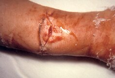 Wound botulism from spore contamination of dirty wounds or in illicit injecting drug use