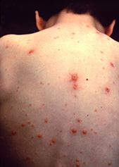Chickenpox And Shingles Sa Health