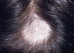fungal infection on the top of the scalp