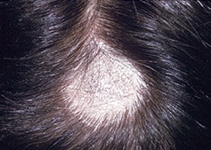 Fungal infections of the hair, skin or nails - including symptoms, treatment and prevention | SA Health Fungal infections of the hair, skin or nails - including symptoms, treatment and prevention | SA Health